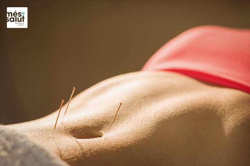 Acupuntura estética corporal barcelona