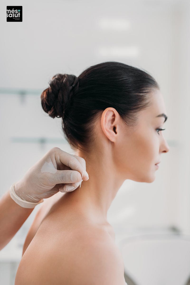 Acupuntura estética corporal barcelona