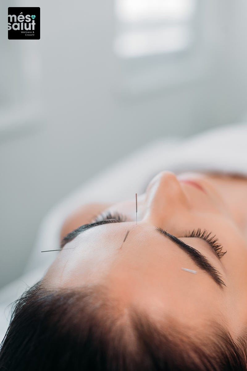 Acupuntura estética facial Barcelona