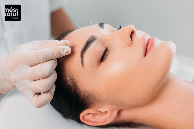 Acupuntura estética facial Barcelona